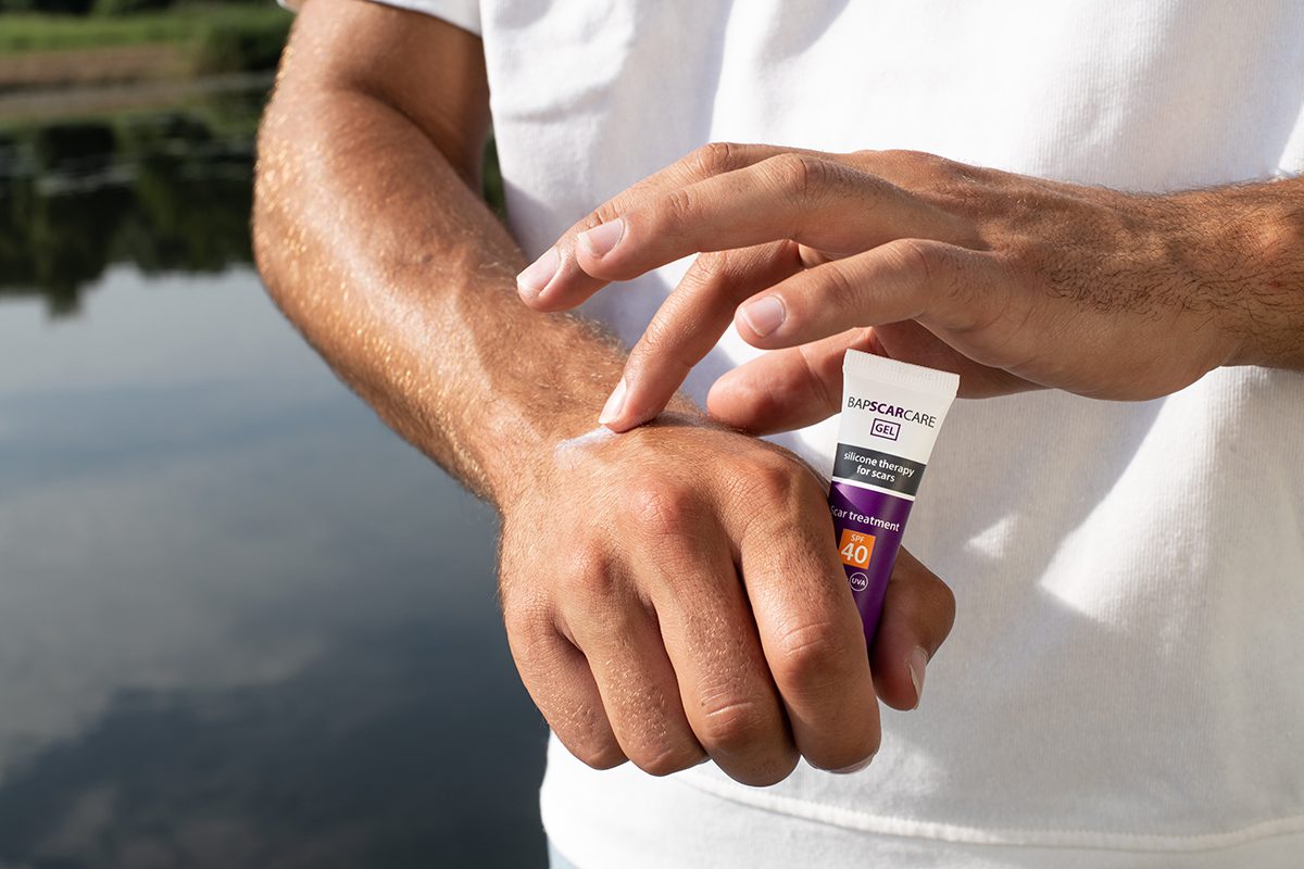 Man using silicone gel for scar on hand after skin surgery