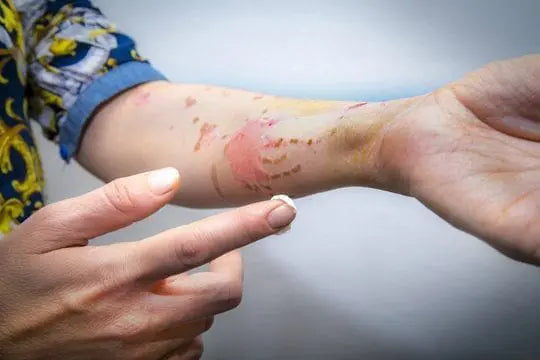 Best Cream for Burn Scars NZ | What Works & When to Start