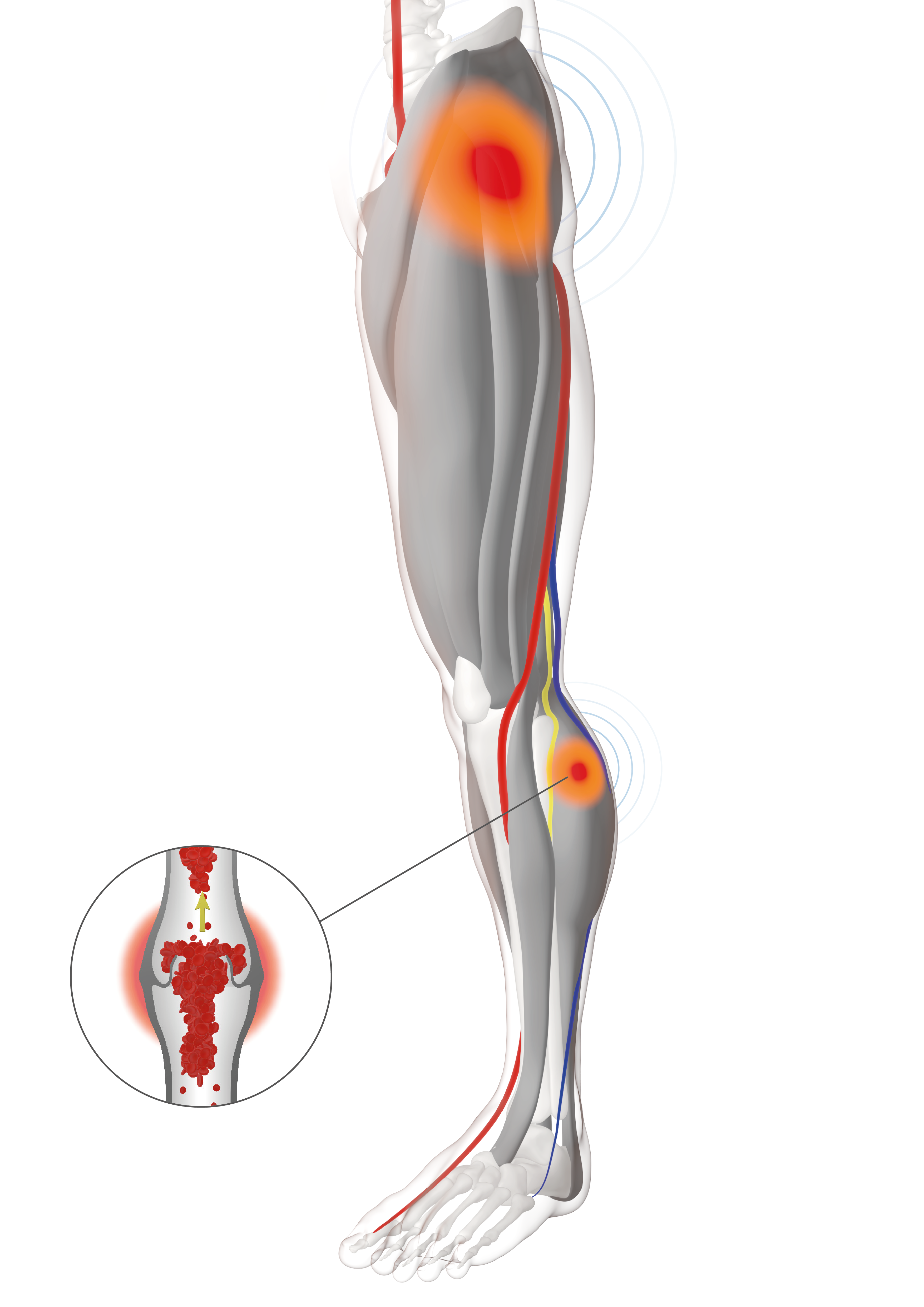 Geko™ T3 Neuromuscular Electrostimulation - VTE Propholaxis & Odema Management Device