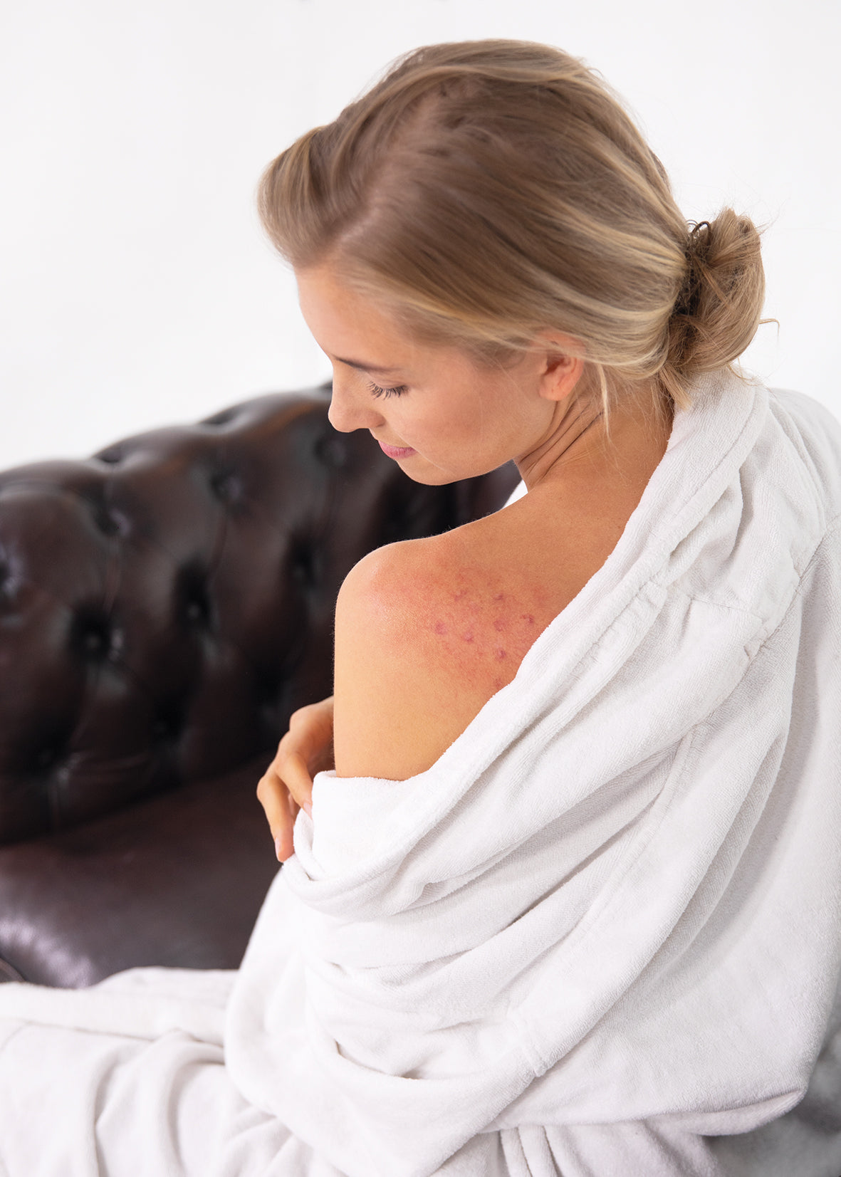 Alhydran anti itch cream for itchy shoulder – fast cooling relief for sensitive skin