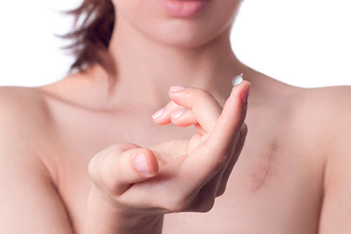 Woman using scar gel on her shoulder after burn recovery