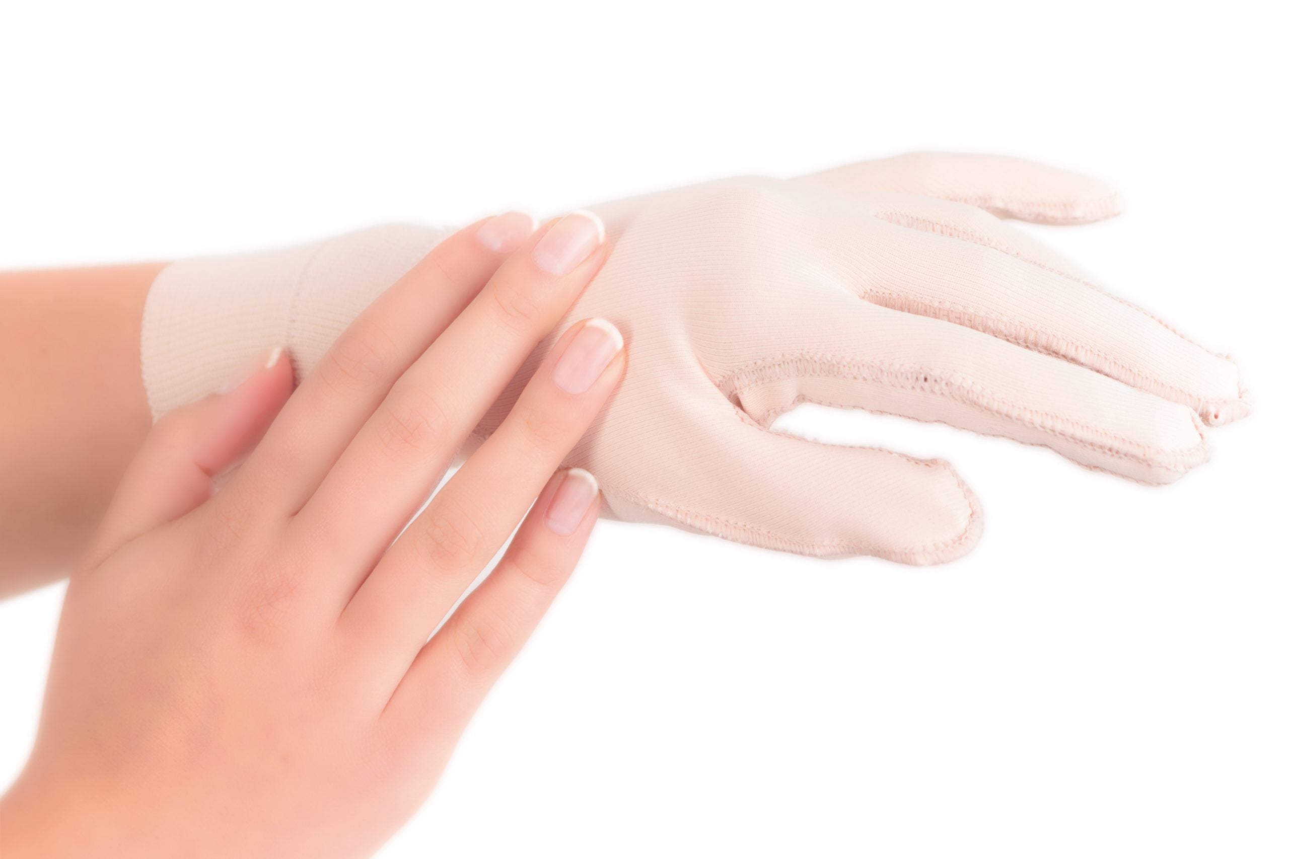 Scarban silicone glove used to treat scars on a grafted hand after burn injury